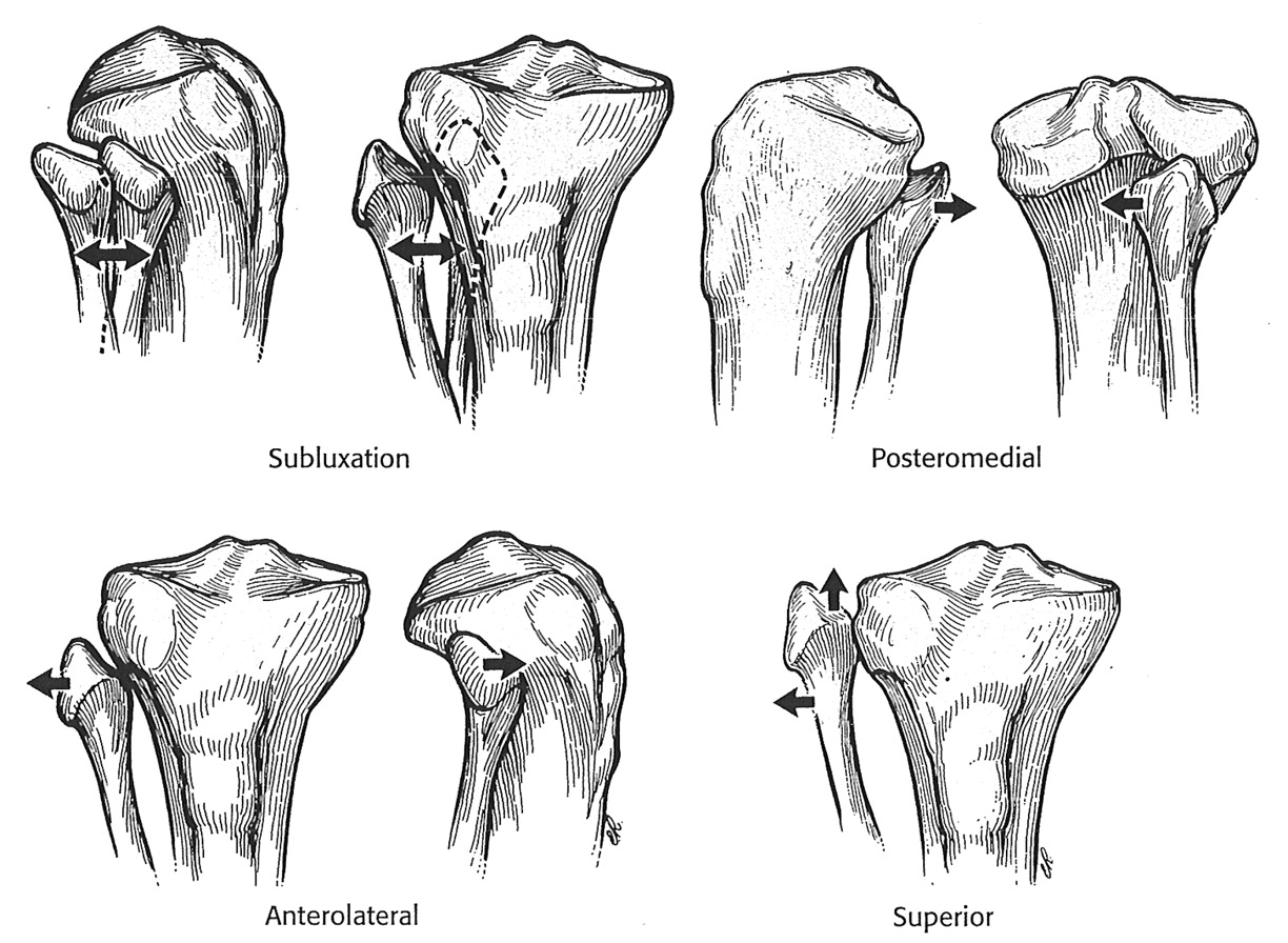 Proximal TibFib Dislocation Knee & Sports Orthobullets
